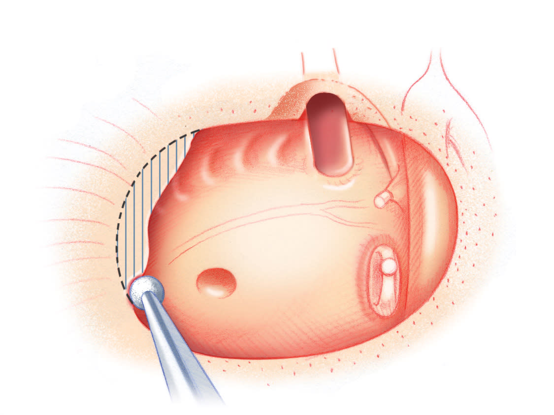 Cerebrospinal Fluid Leak | Jackler Collection | Volumes Cerebrospinal Fluid Leak | Jackler Collection | Volumes